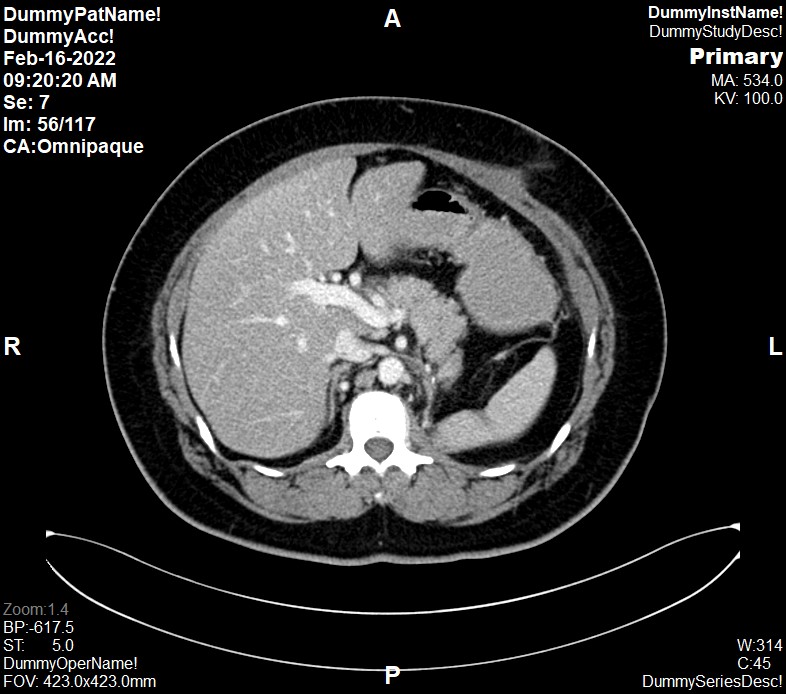 The axial cut image of CT TAP at the level of liver. The image shown the portal vein is in-phase of contrast enhancement.