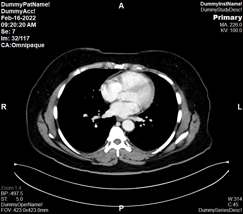 This is the axial cut of CT TAP at the level of mediastinum. The contrast enhancement shown great contrast during late arterial phase.